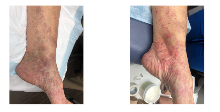 Treating Ankle Spider Veins Aesthetic Vein Training